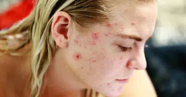 Comment soigner l'eczéma au naturel ?